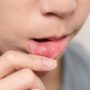 Чому в роті з’являються виразки і як їх лікувати