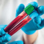 Вчені назвали групу крові, яка підвищує ризик тромбів