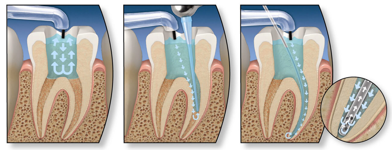 Зубний канал
