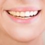 Стоматолог пояснив, чому жовтіють зуби